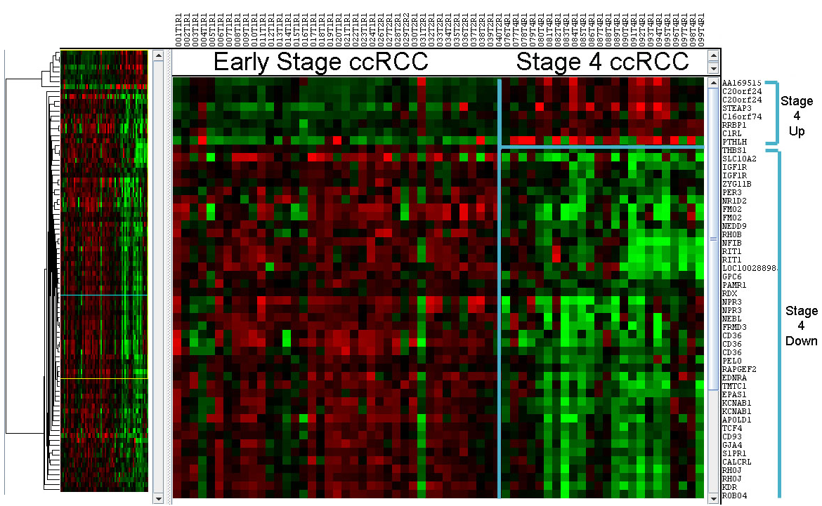 Gene expression heatmap for ccRCC early vs late stage